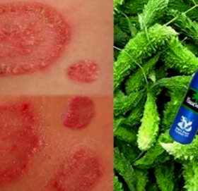 पुरानो भन्दा पुरानो वा जिद्धी दादलाई ३ दिनमै निर्मुल पार्ने यो चमत्कारिक घरेलु औषधी, जानीराखौँ