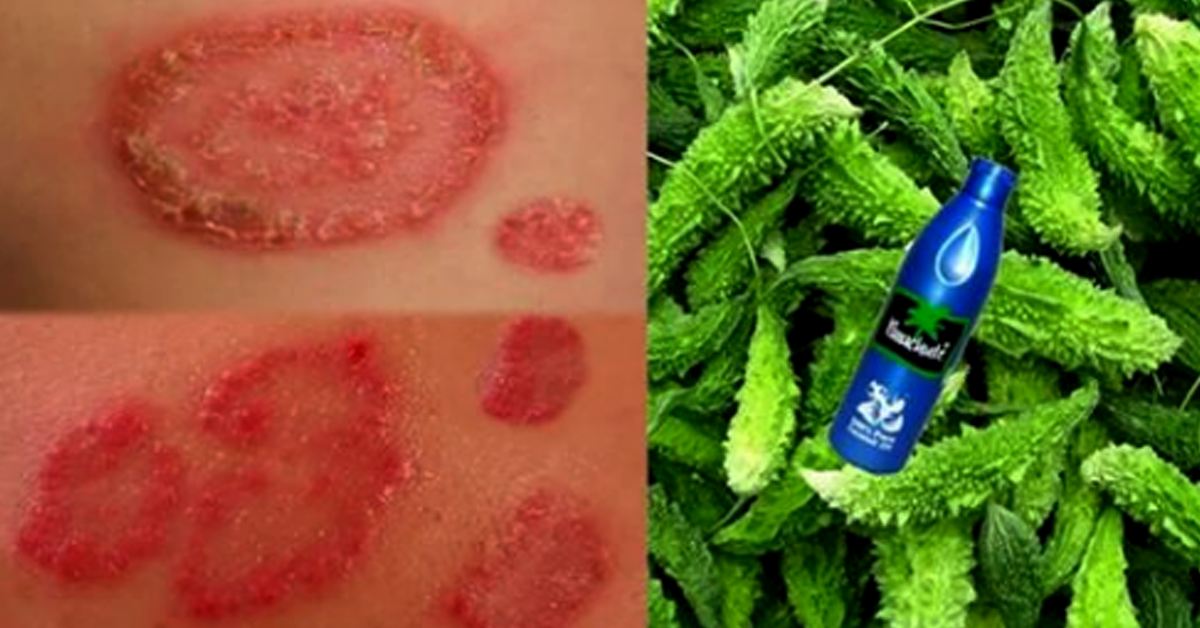 पुरानो भन्दा पुरानो वा जिद्धी दादलाई ३ दिनमै निर्मुल पार्ने यो चमत्कारिक घरेलु औषधी, जानीराखौँ