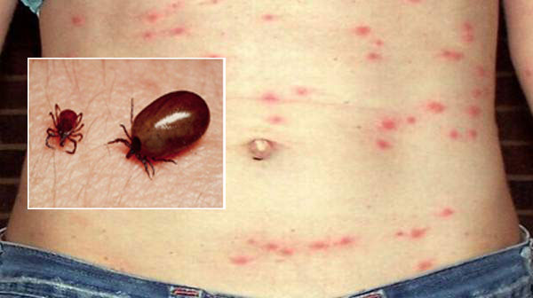 बाजुरामा पनी स्क्रब टाइफसका बिरामी फेला