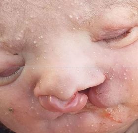 नाक र मुख नछुट्टिएको बच्चा जन्मिएपछि….