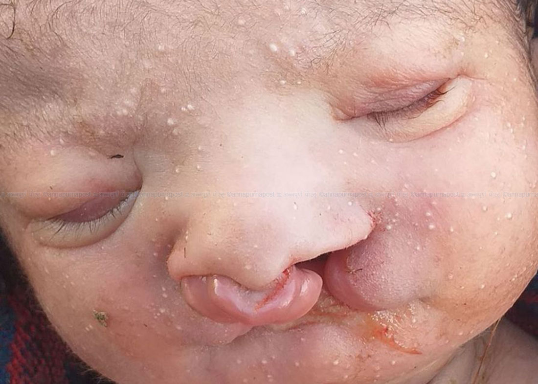 नाक र मुख नछुट्टिएको बच्चा जन्मिएपछि….