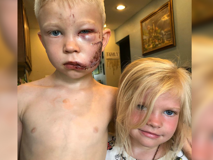 बहिनीलाई बचाउन ६ वर्षका बालक कुकुरसँग भिडे, अनुहारमा ९० टाँकाः वर्ल्ड बक्सिङ काउन्सिलको उपाधि प्रदान