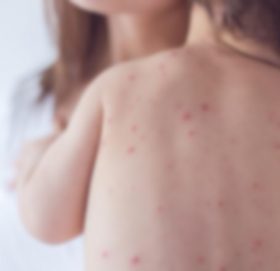 बैतडीमा भेटिए दादुरा-रुबेलाका बिरामी