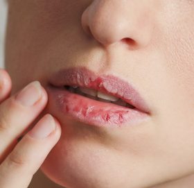 किन फुट्छ ओठ ? थाहा नभएका ५ कारण
