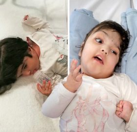 टाउको जोडिएका जुम्ल्याहा अपरेशनपछि घर फर्किए