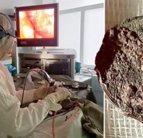 ५० वर्षपछि निकालियो नाकमा अड्किएको सिक्का