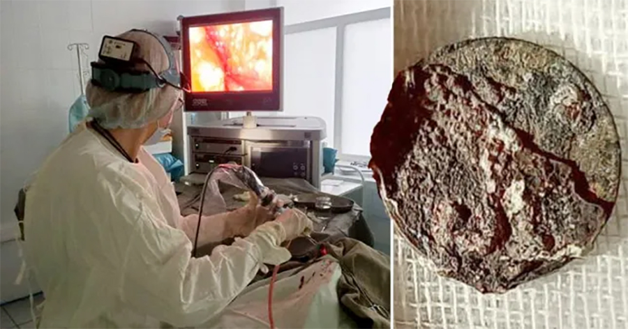 ५० वर्षपछि निकालियो नाकमा अड्किएको सिक्का