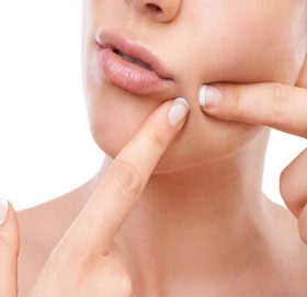 डन्डिफोर कहिल्यै निको भएन ? अब गर्नुस् यी ४ सरल उपाय