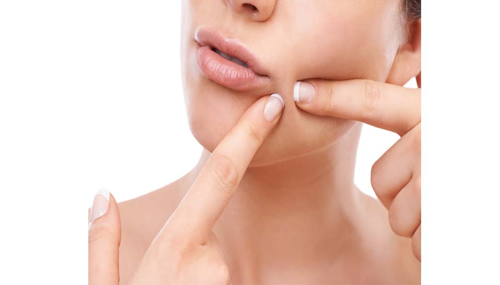 डन्डिफोर कहिल्यै निको भएन ? अब गर्नुस् यी ४ सरल उपाय