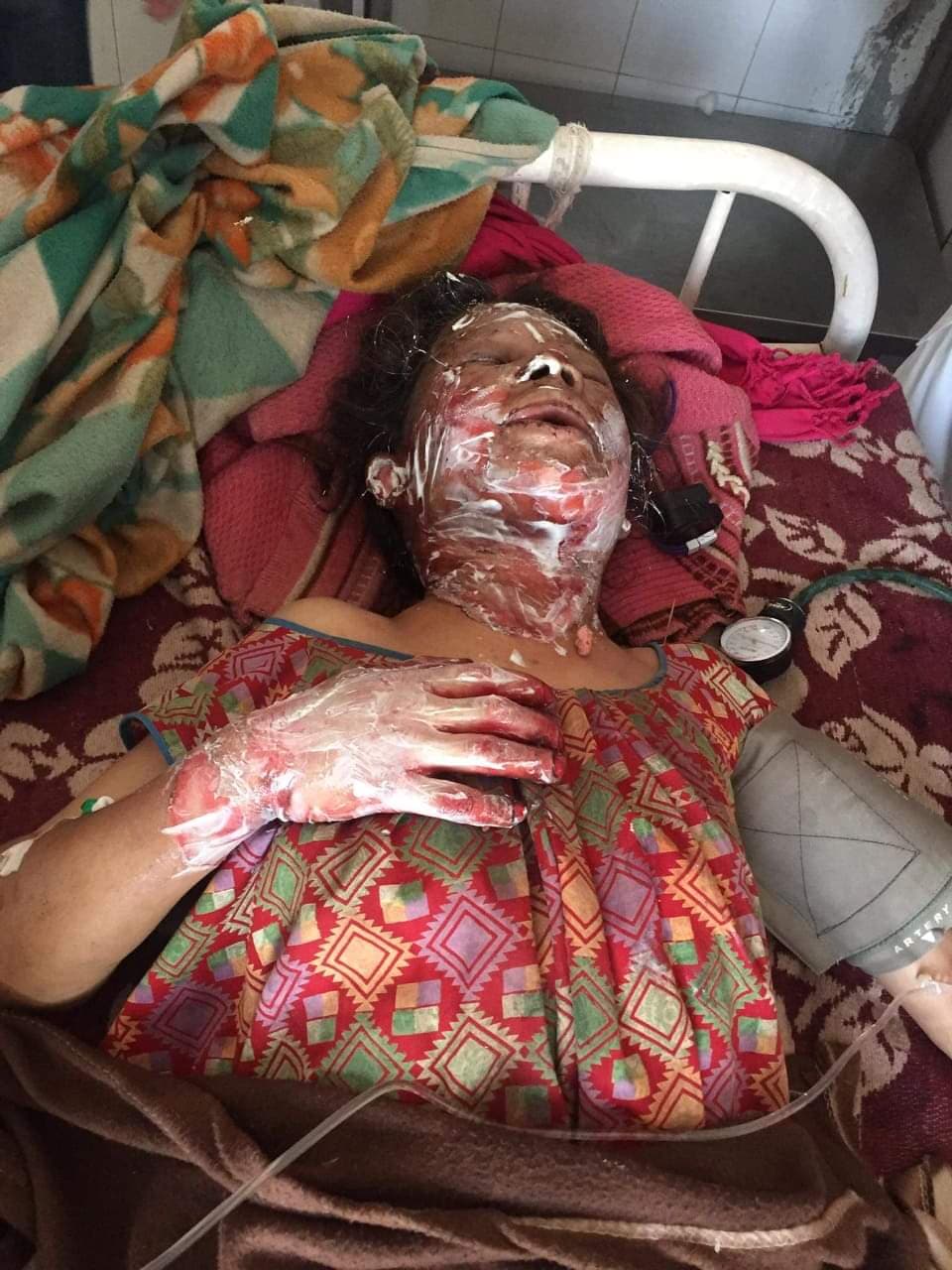 जंगलमा लागेको डढेलोले जलेर घाइते भएकि महिलालाई उपचारमा आर्थिक समस्या