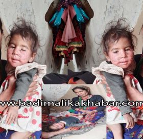 आर्थिक अभाबमा कुपोषित दलित बालिका अलपत्र