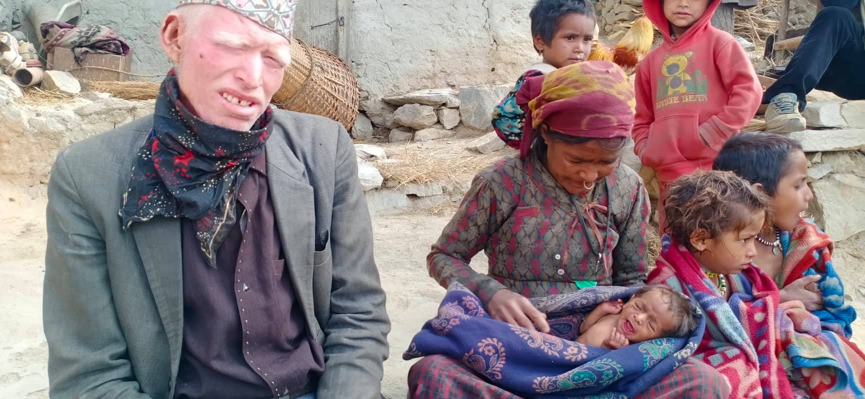 उपचार अभाबमा कुुपोषित बच्चा जिवनमरणको दोसाधमा