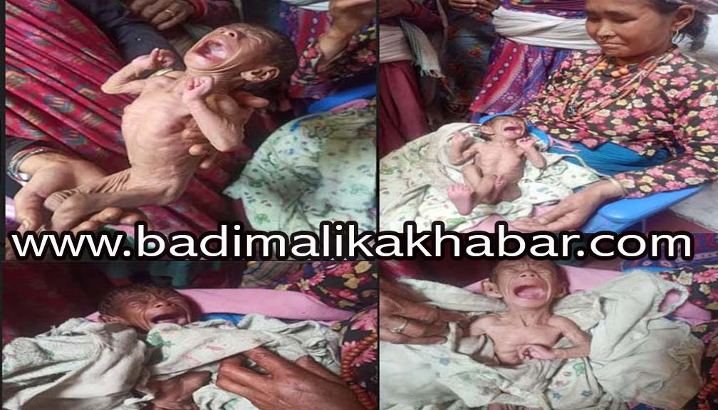 कुपोषण कहर : कुपोषित डेढ महिनाकी बालिका जिवन मरणको दोसाधमा