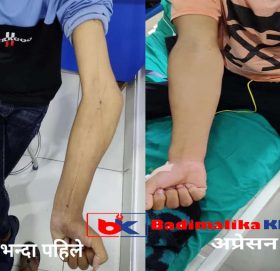 बाजुराका लालबहादुरको १० वर्षअघि बाङ्गो जोडिएको हात निसर्ग अस्पतालले सोझो बनाइदिएपछि…….