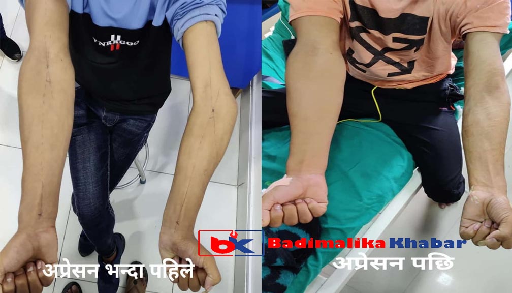 बाजुराका लालबहादुरको १० वर्षअघि बाङ्गो जोडिएको हात निसर्ग अस्पतालले सोझो बनाइदिएपछि…….