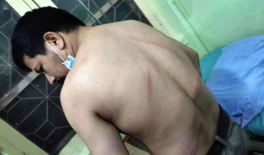 प्रहरीको लाठी चार्जबाट घाइते बाजुराका विद्यार्थी नेता नरेशकाे फोटो सामाजिक सञ्जालमा छ्यापछ्याप्ती