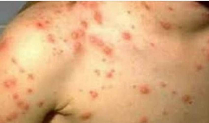 बढ्न थाले स्क्रबटाइफस रोगका बिरामी