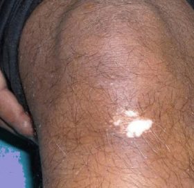 शरीरमा सेतो दाग किन देखिन्छ र कसरी हटाउने ? (उपायसहित)