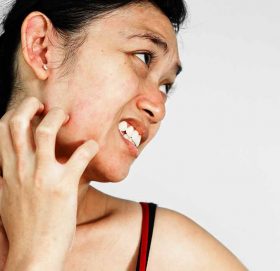 बर्खे एलर्जीले सतायो ? यसो गर्नुस्