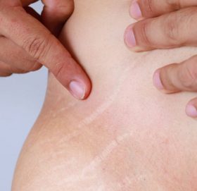 के छालामा आउने स्ट्रेच मार्कको उपचार सम्भव छ ?