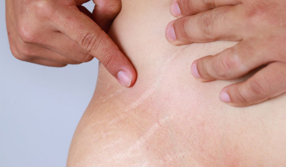 के छालामा आउने स्ट्रेच मार्कको उपचार सम्भव छ ?