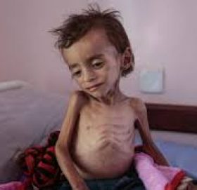 कञ्चनपुरमा ६०२ जना कुपोषित बालबालिका भेटिए