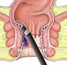 पायल्सको लेजर सर्जरी कति सुरक्षित छ ? अन्य उपचार के के हुन् ?