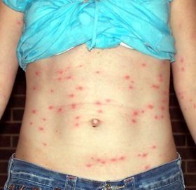 कोभिड–१९ जस्तै लक्षण भएको ‘स्क्रब टाइफस’ देखिन थाल्यो