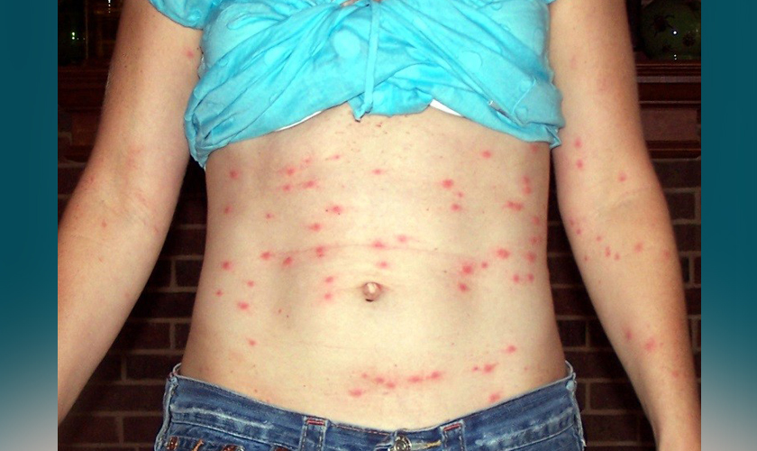 कोभिड–१९ जस्तै लक्षण भएको ‘स्क्रब टाइफस’ देखिन थाल्यो