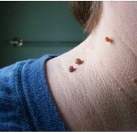 हातखुट्टामा मुसा आएर हैरान हुनुहुन्छ ? यस्तो छ घरेलु उपचार विधि