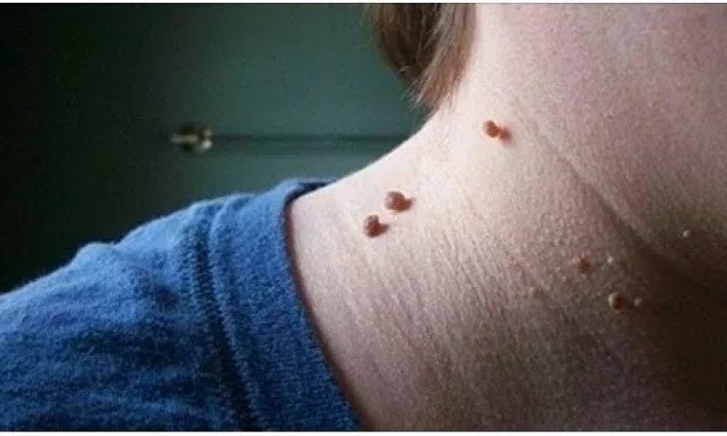 हातखुट्टामा मुसा आएर हैरान हुनुहुन्छ ? यस्तो छ घरेलु उपचार विधि