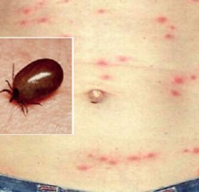 बैतडीमा स्क्रब टाइफसको जोखिम बढ्यो, ४५ जनामा सङ्क्रमण