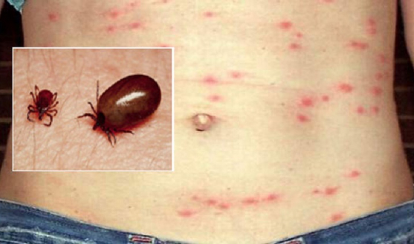 बैतडीमा स्क्रब टाइफसको जोखिम बढ्यो, ४५ जनामा सङ्क्रमण