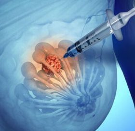 साथ पाए जित्न सकिन्छ क्यान्सर