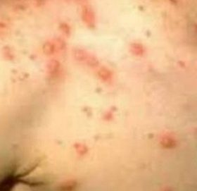 स्क्रब टाइफसबाट कसरी बच्ने ?