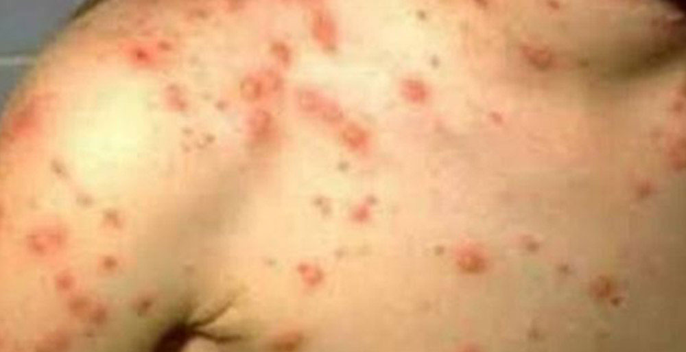 स्क्रब टाइफसबाट कसरी बच्ने ?