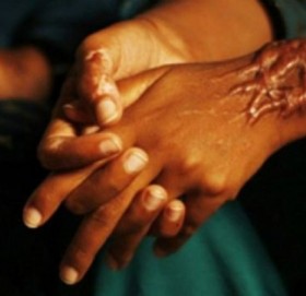 बुबाले छ्यापेको एसिड लागेर छोराछोरी घाइते