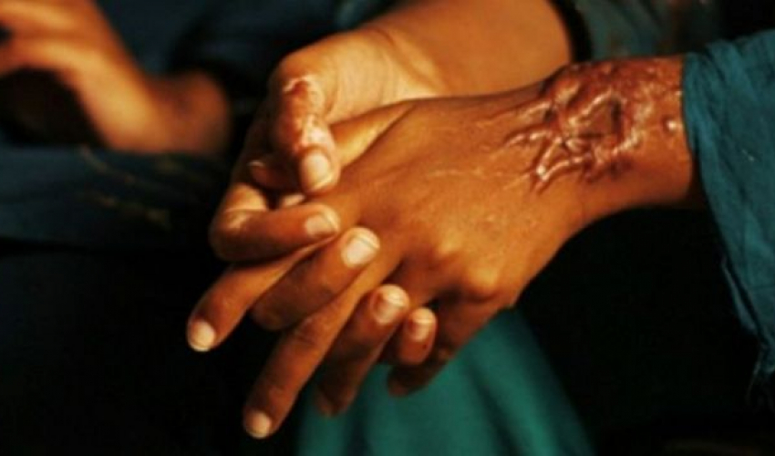 बुबाले छ्यापेको एसिड लागेर छोराछोरी घाइते