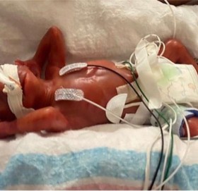 सबैभन्दा कम समयमा जन्मिएको शिशु !