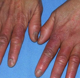 जाडोमा बढ्दै छालाको समस्या, के छ समाधानको उपाय ?