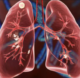 प्रदूषणले फोक्सो बिगारिदिन्छ, यी खानेकुरा खाएर जोगाउनुहोस्