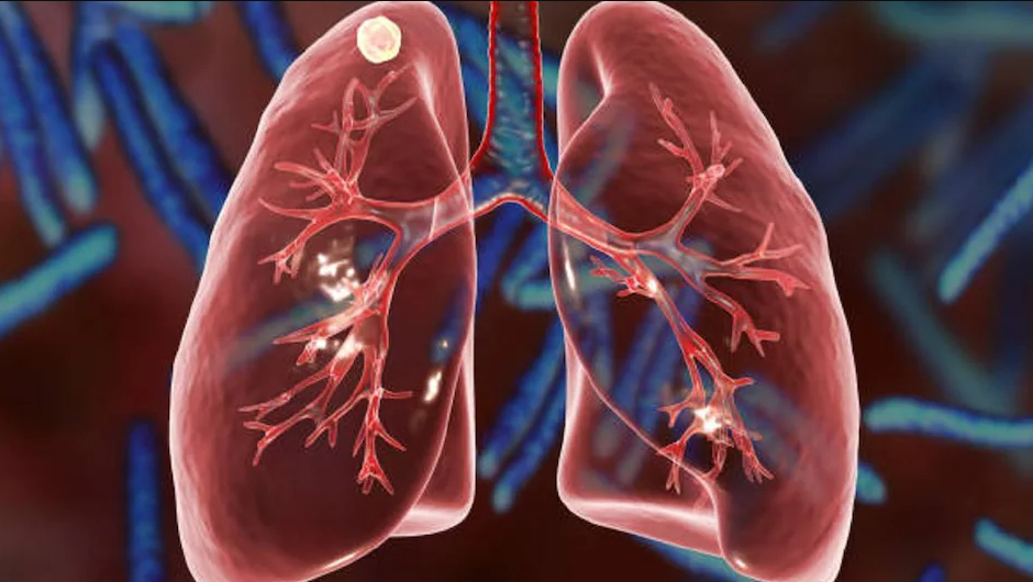 प्रदूषणले फोक्सो बिगारिदिन्छ, यी खानेकुरा खाएर जोगाउनुहोस्