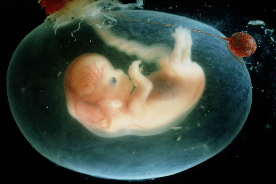 गर्भ रहेको ३५ वर्षसम्म महिलाको पेटमा ७ महिनाको बच्चा !