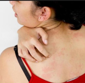 चिसो बढेसँगै छालामा संक्रमण बढ्यो, सावधानी अपनाउन चिकित्सकको आग्रह