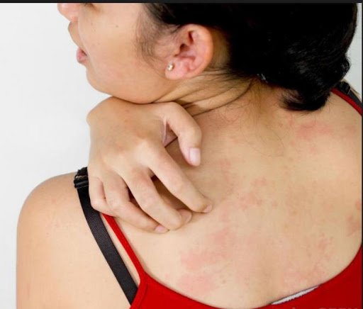 चिसो बढेसँगै छालामा संक्रमण बढ्यो, सावधानी अपनाउन चिकित्सकको आग्रह