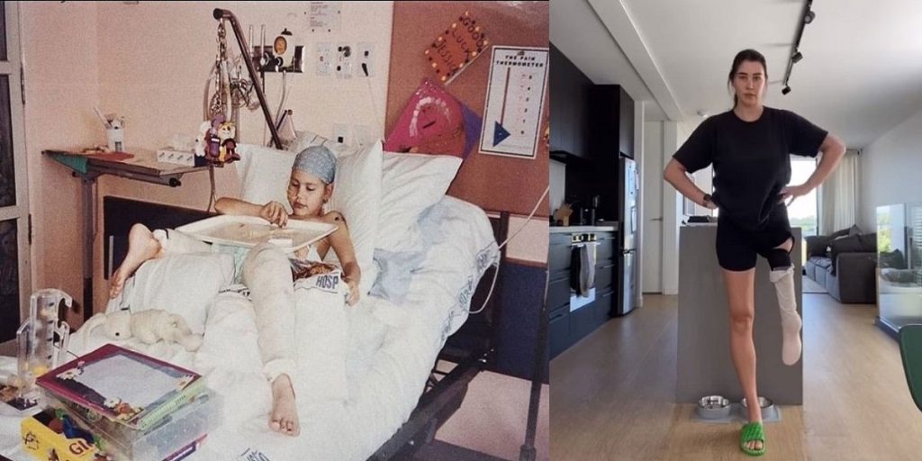 जब युवतीको शरीरमा डाक्टरले जोडिदिए उल्टो खुट्टा !