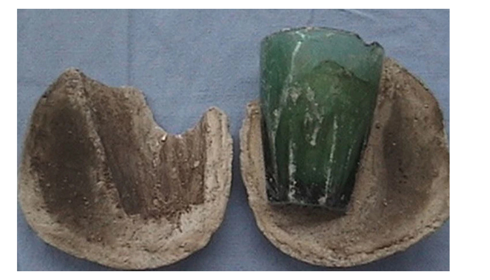 महिलाको गोप्य अंगमा चार वर्षदेखि अड्किएको थियो काँचको गिलास