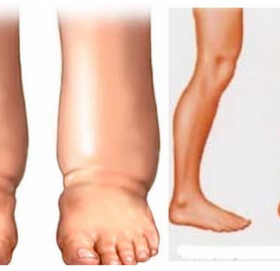 आजदेखि हात्तिपाइले विरुद्धको औषधि खुवाइँदै