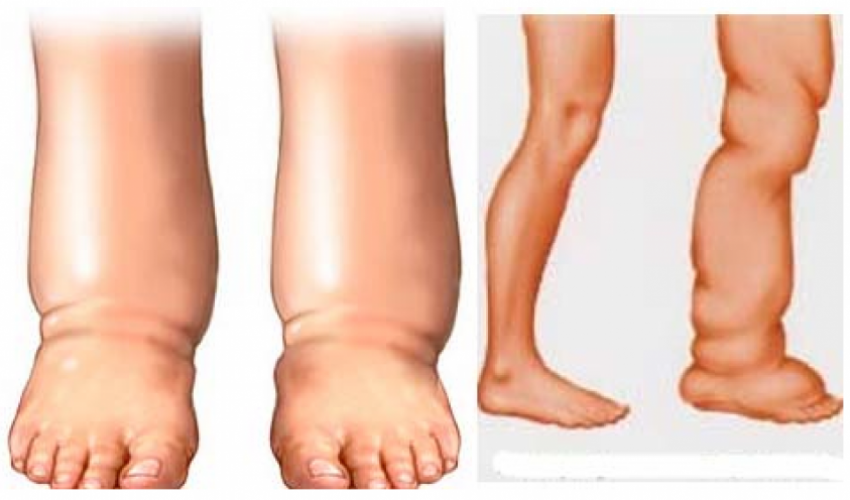 आजदेखि हात्तिपाइले विरुद्धको औषधि खुवाइँदै