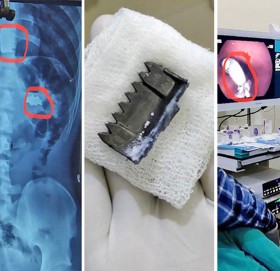 विरामीको पेटबाट निकालियो फलामको सिक्री र पेटीको बकल